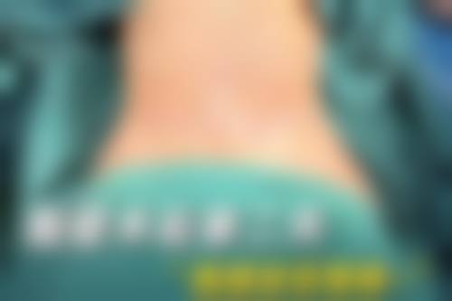 吸脂后多久见效？1-3个月塑形明显，6个月效果稳定！附腰腹吸脂真实案例对比