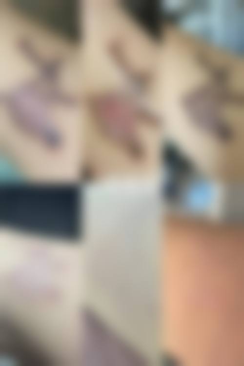 脂肪移植丰胸有什么后遗症