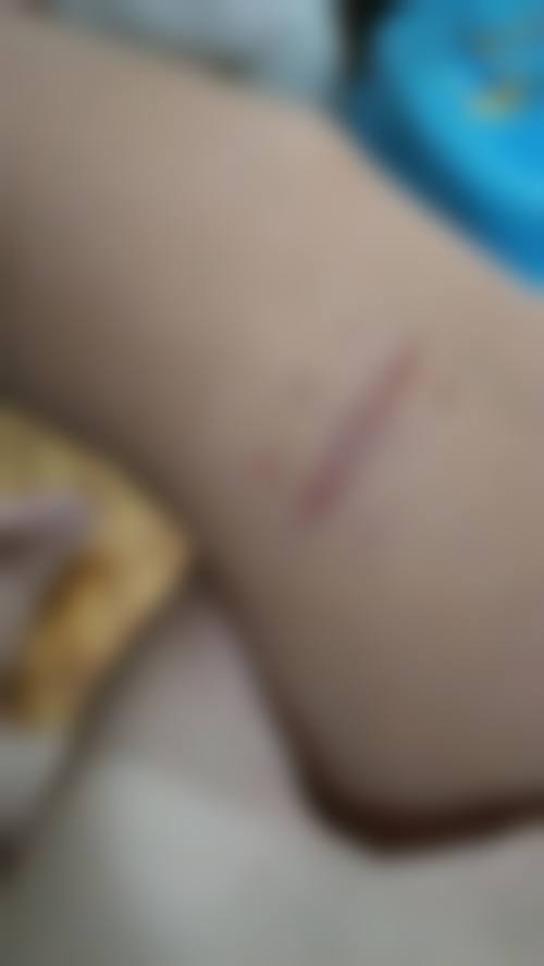 艾灸治疗手术疤痕的操作路径与方案选择