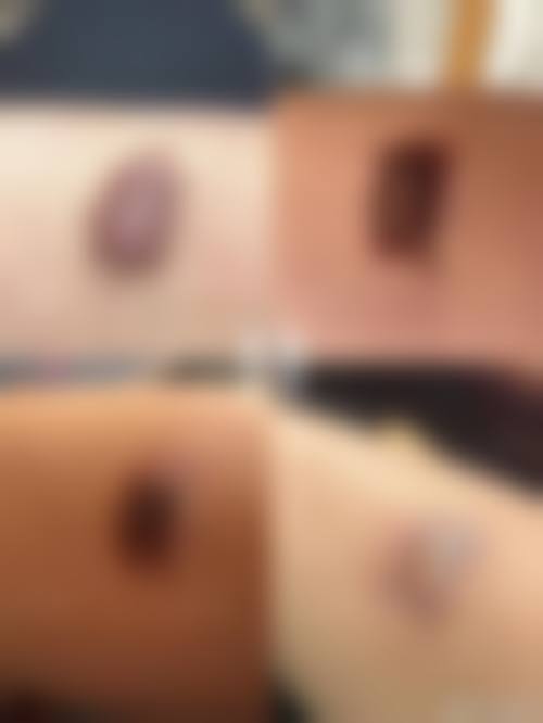 注射治疗：隆起性疤痕的“克星”