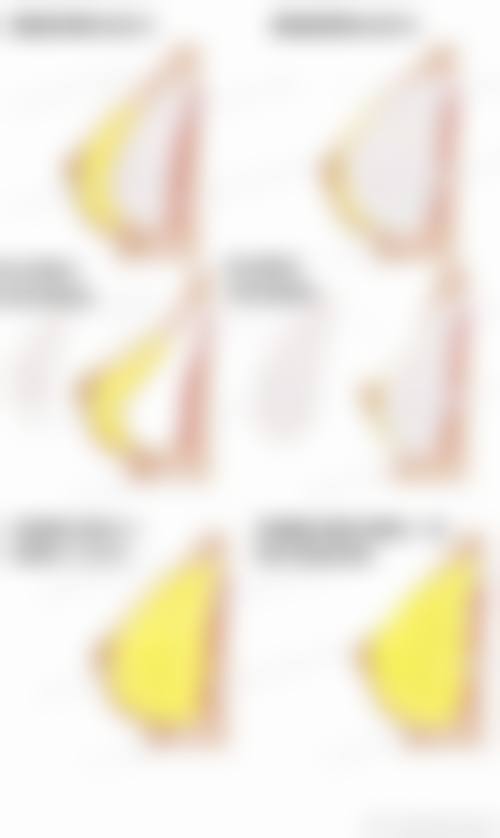 适合脂肪移植隆胸的人群有哪些？