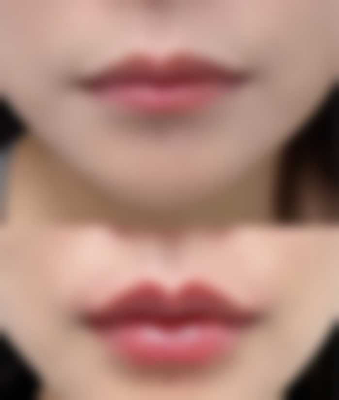 头发种植术后生长时间的常见认知偏差与误解