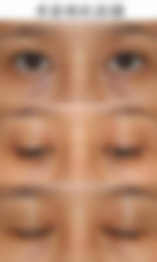 割眼袋常见并发症或后遗症，真实发生概率如何？