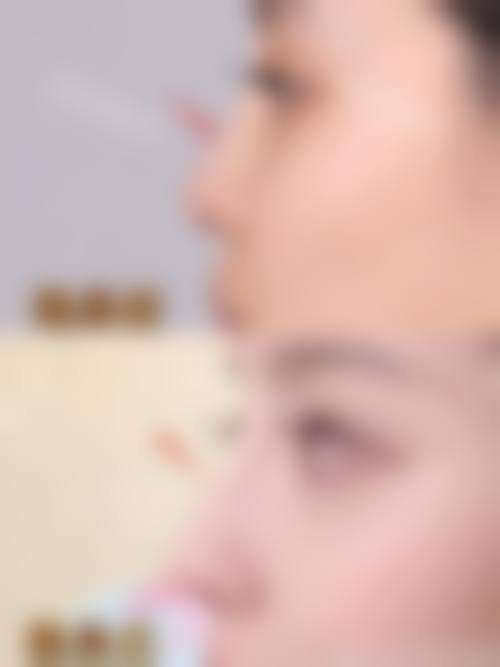 膨体和假体隆鼻怎么选择医院医生及国内医院医生推荐