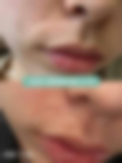 {怎么治疗疤痕疙瘩？药物/激光/注射3大疗法有效缓解，2026费用及效果全解析！