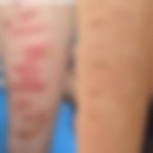 去除疤痕黑印的方法哪家强?深入对比看疗效