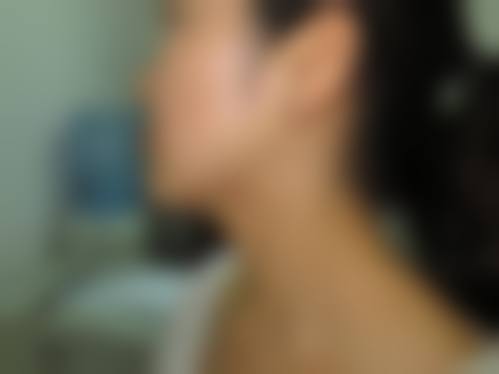 消除疤痕印黑色素,价格费用大揭秘