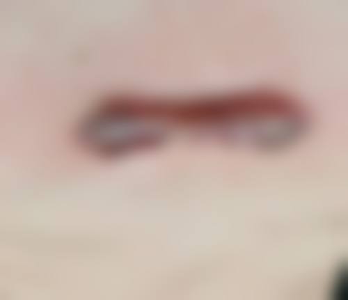 疤痕疙瘩激光手术治疗做决定前,普通用户更容易忽略的问题