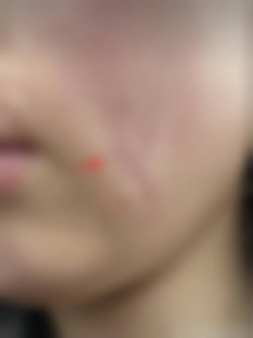 疤痕疙瘩激光手术治疗常见并发症或后遗症,真实发生概率如何?