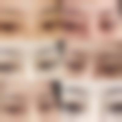 九、围绕一次性双眼皮,临床中更常见的并发问题有哪些?