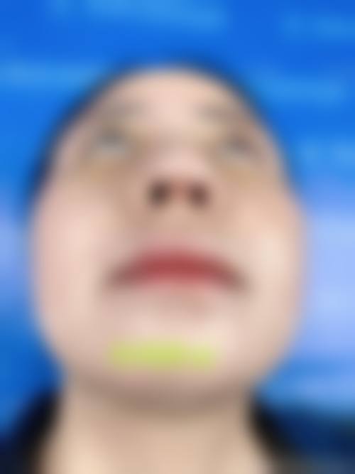 怎么判断我是否适合膨体或假体隆鼻项目？