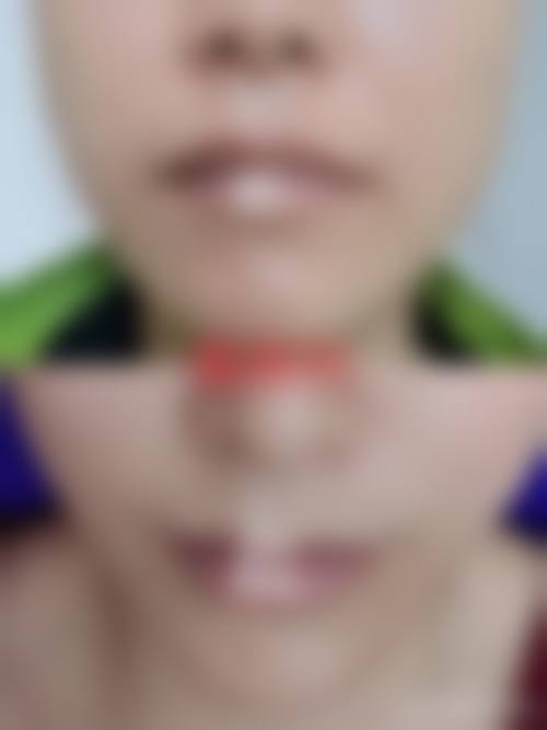 打瘦脸针的有危害吗？有！可能引发面部僵硬、感染等问题，选正规机构能降低风险！正规打瘦脸针后遗症可控，价格2000 - 10000元不等 