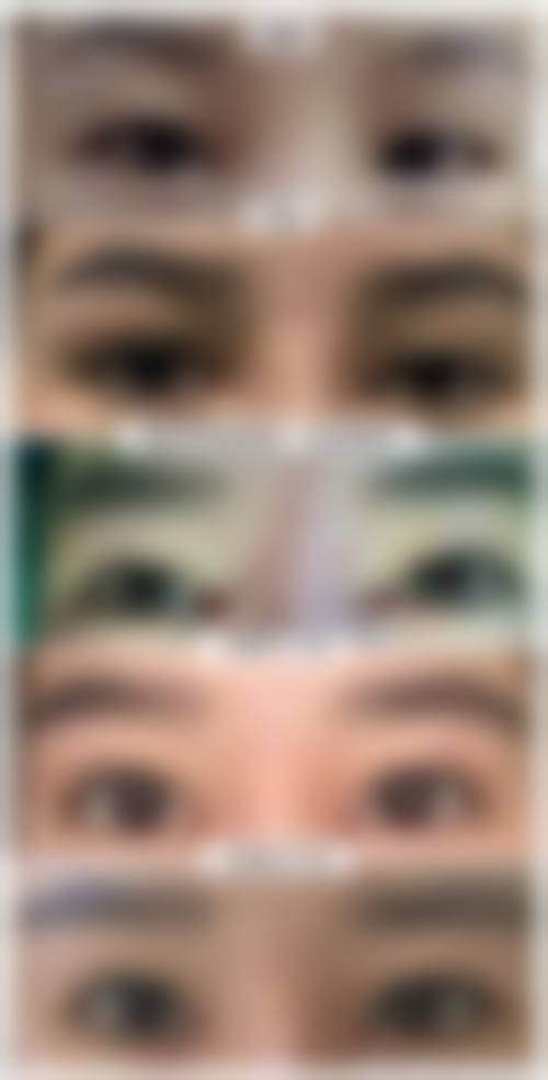 {双眼皮割深了是什么原因？原来是医生操作失误、术前设计不合理及眼部解剖结构特殊在“作祟”！割深后咋改善？修复手术、注射填充有办法！ 