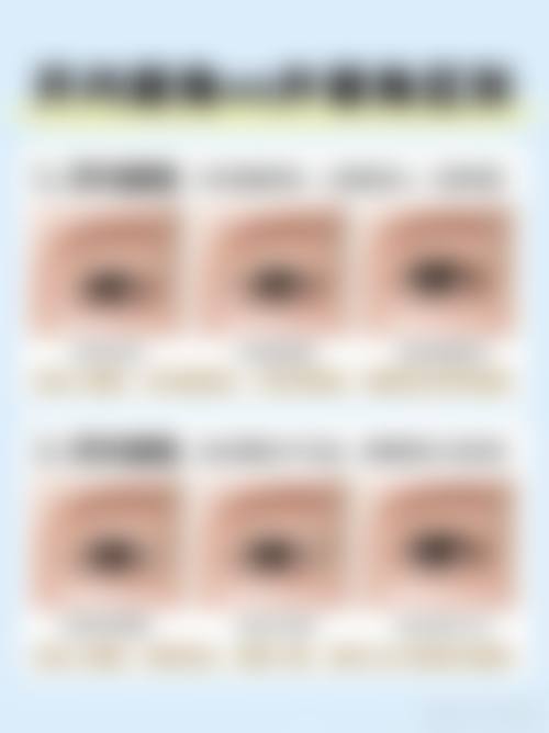 双眼皮割深后如何改善