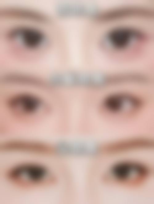 从医学角度看，双眼皮割深修复手术的风险主要集中在哪些环节？