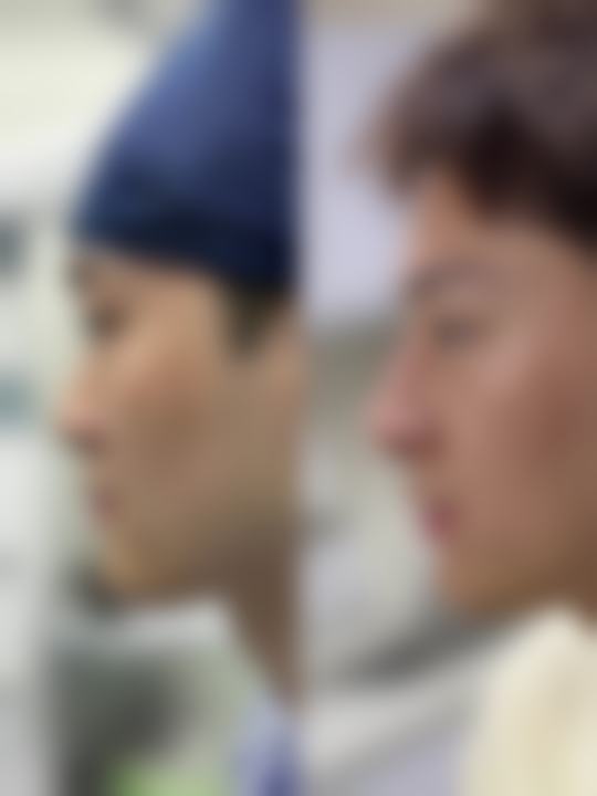 隆鼻手术出院相关因素有哪些？