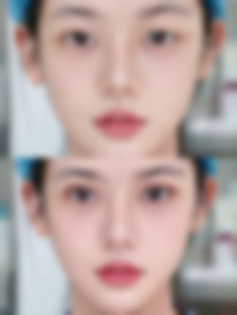 割眼袋技术本身的优势与局限