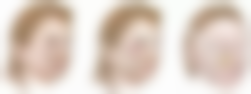 丰太阳穴常见并发症或后遗问题,在临床中如何理解其发生概率?