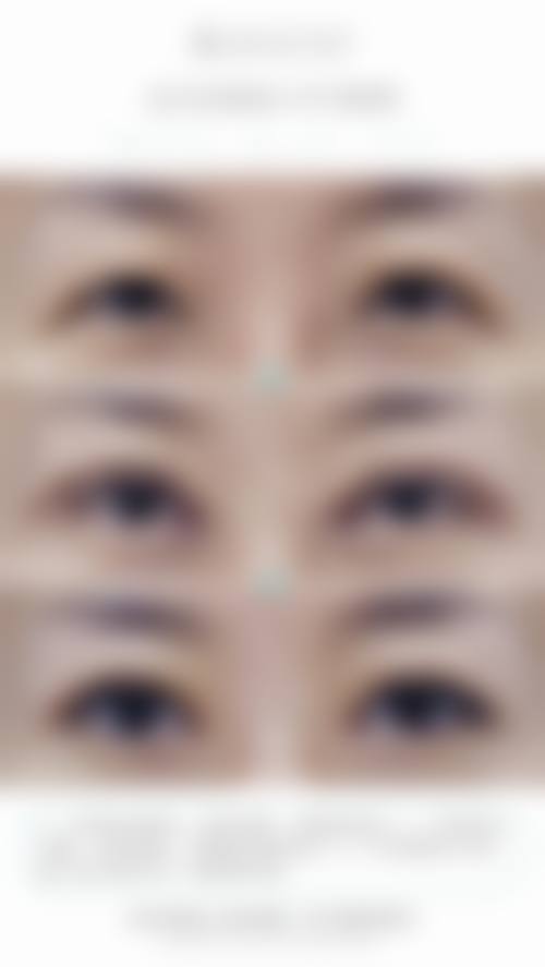 双眼皮手术成效不明显修复是什么?通常在什么医学背景下被选择?
