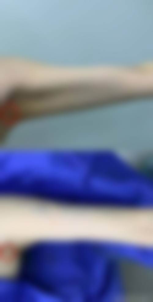 手臂吸脂穿塑身衣是什么?通常在什么医学背景下被选择?