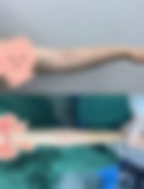 哪些人群在评估中更可能被建议考虑手臂吸脂穿塑身衣?