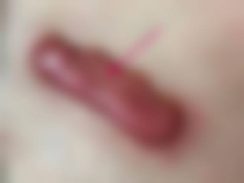 激光祛疤本身能解决什么、不能解决什么?