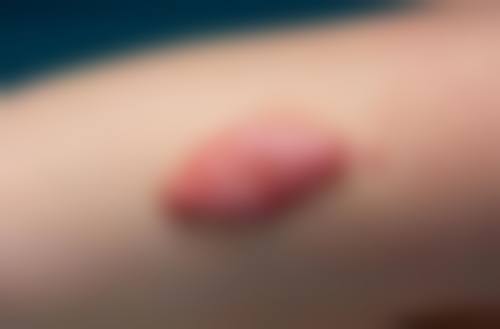 涂抹药膏百元搞定的成效评估