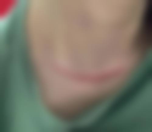 从医学角度看,激光祛疤的风险主要集中在哪些环节?