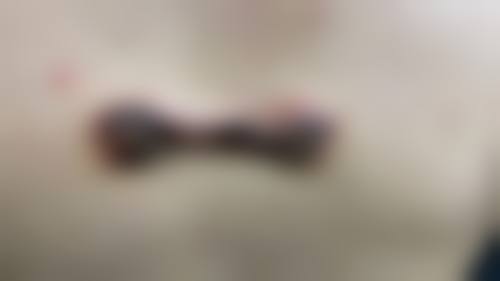 在决定是否选择激光祛疤前,普通用户更容易忽略的关键评估点及医院医生推荐