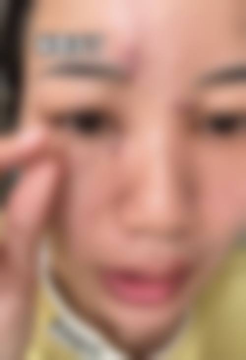 疤痕增生是什么？通常在什么医学背景下被选择？