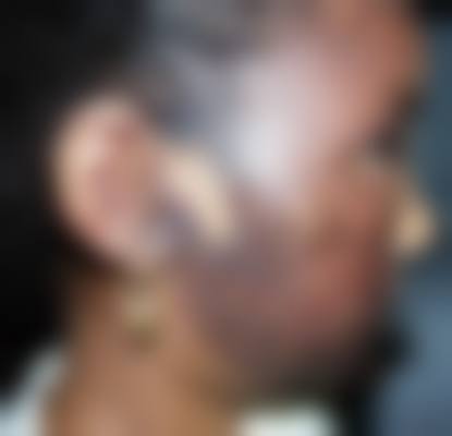 哪些人群在评估中更可能被建议考虑激光祛疤?