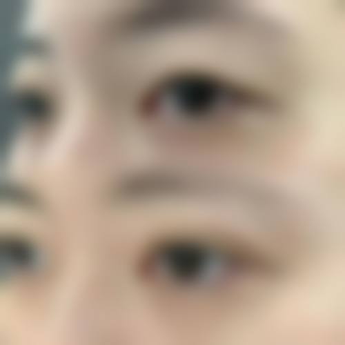 双眼皮线结反应怎么办？别慌！及时就医、合理护理、必要时拆线处理来搞定！掌握热敷、手术修复等方法不踩坑 