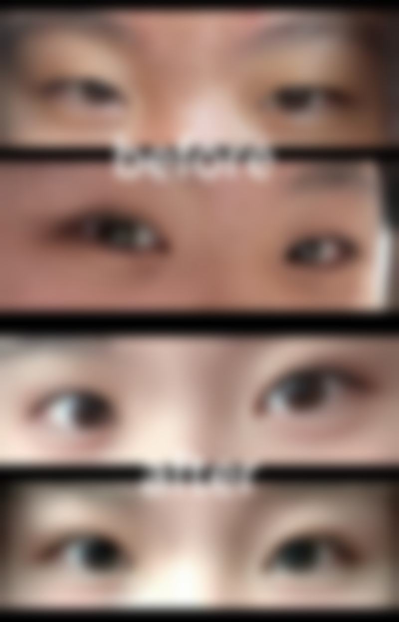 双眼皮不对称日常护理方法有哪些?