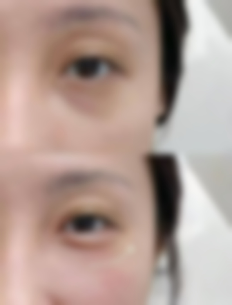 丰太阳穴有没有风险？当然有！感染、移位、不对称全揭秘，教你多招规避风险！ 