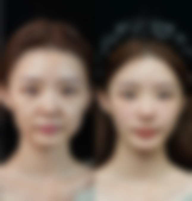 从医学角度看,双眼皮手术成效不明显修复的风险主要集中在哪些环节?