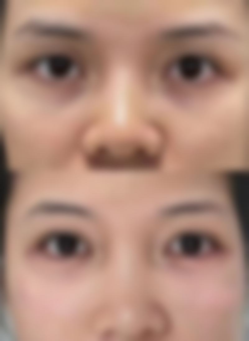 不同方案下内切祛眼袋维持时间的常见区间