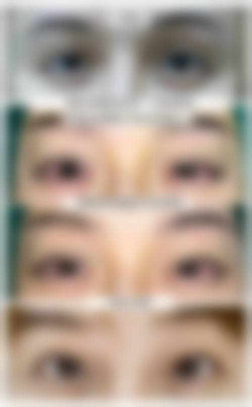 隆鼻和眼睛联合手术是什么?通常在什么医学背景下被选择?