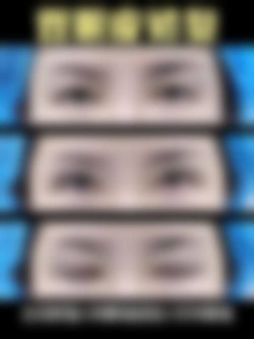 去眼袋保留卧蚕在什么医学背景下被选择?