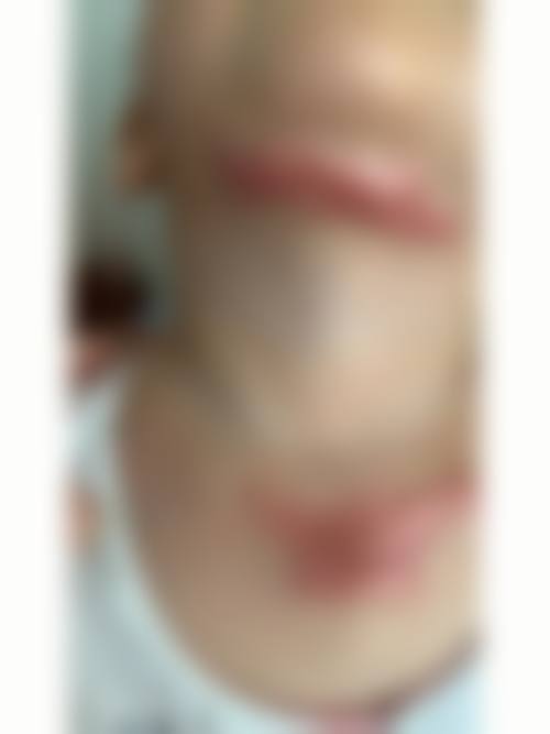 幼儿疤痕去除常见误解与容易混淆的点