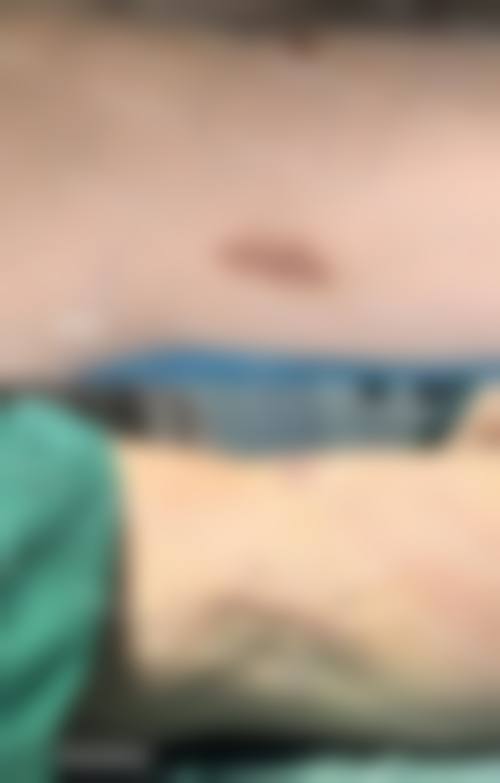 哪些幼儿适合不同的疤痕去除方法