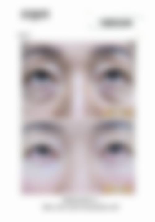 在决定是否选择去眼袋保留卧蚕前,普通用户更容易忽略的关键评估点及医院医生推荐名单