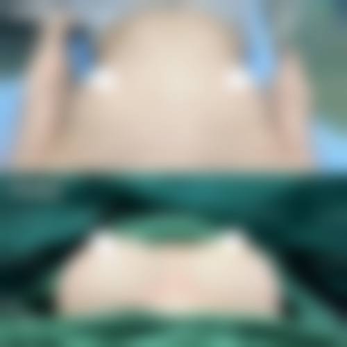 魔滴隆胸假体的记忆功能与手术成效