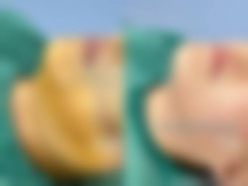 瘦脸针蛙腮会自己修复吗？