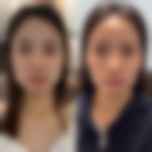 {瘦脸针蛙腮是没打好吗？是的！从药物分布不均、注射层次有误两方面为你详细剖析！出现蛙腮后还能瘦脸吗？如何处理看这里 