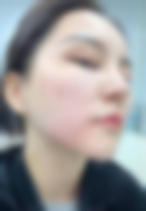 瘦脸针出现蛙腮后还能瘦脸吗？