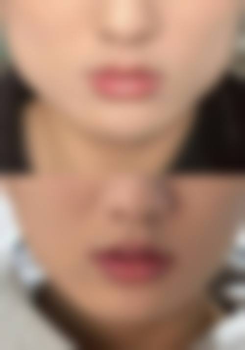 瘦脸针蛙腮是没打好的表现吗？