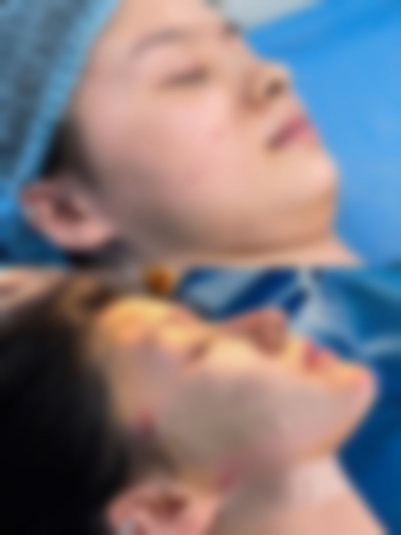 {隆鼻和眼睛可以一起做吗？当然可以！手术时间更短、恢复周期不叠加且性价比超高！隆鼻和眼综合多久恢复？费用3-8万给你完美改变！ 