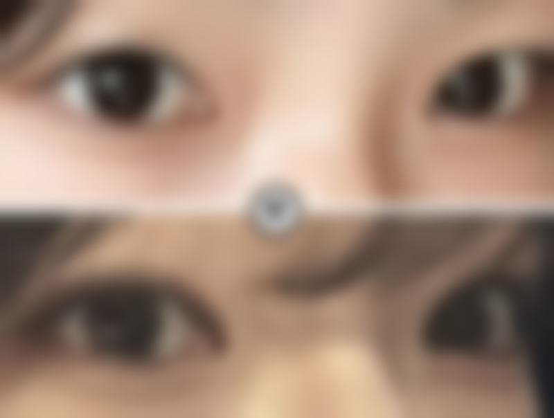 医生操作对去眼袋保留卧蚕的影响