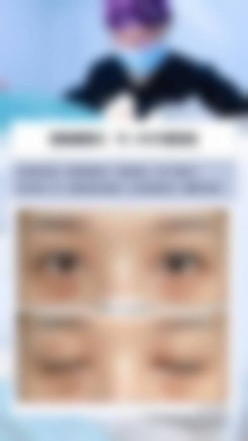 贴双眼皮贴修复双眼皮的成效与危害