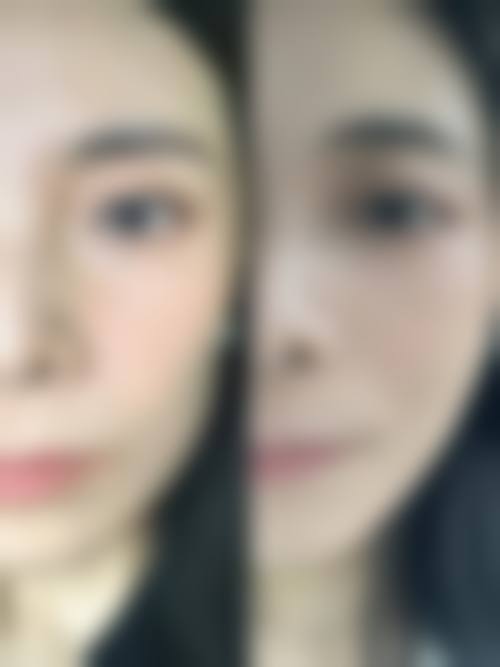 五、在实际操作中，深蓝射频除皱更适合哪些人？